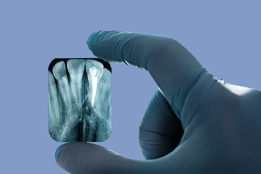 Hand in blauen handschuhen hält kleines Röntgenbild hoch, das die Füllung eines Wurzelkanals zeigt.